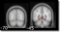 figure_alzheimer_2